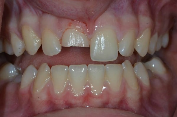 Before